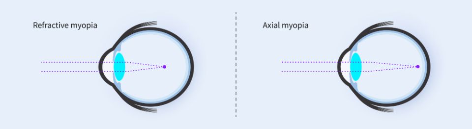 Refractive vs. axial myopia