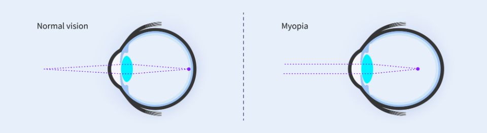 What is myopia? 
